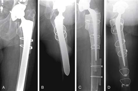 Cemented Femoral Revision In Total Hip Arthroplasty Musculoskeletal Key