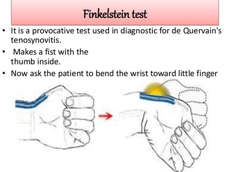De Quervains Tenosynovitis Causessymptomsdiagnosis And Treatment