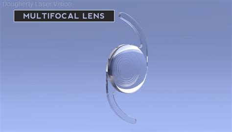 Cataract Surgery Lens Options Dlv Vision