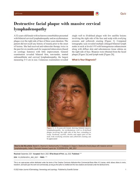 Pdf Destructive Facial Plaque With Massive Cervical Lymphadenopathy
