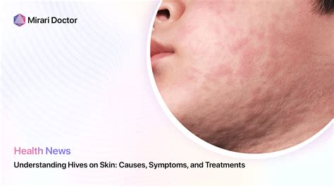 Understanding Hives On Skin Causes Symptoms And Treatments