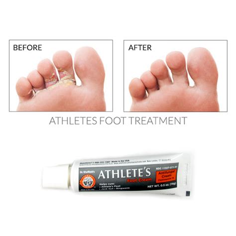 Athletes Foot Antifungal Cream Treatment Jock Itch Ringworm Itching