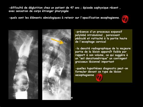 Difficult De D Glutition Chez Un Patient De Ans Pisode Asphyxique R Cent Avec