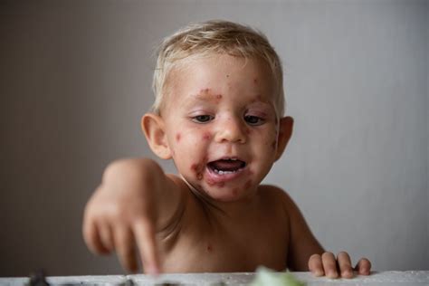 Fotos De Impetigo Em Bebê