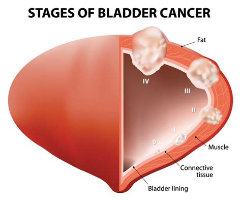 Bladder Cancer