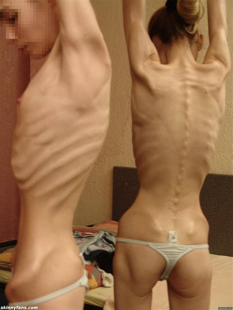 Nude Anorexic Women Telegraph