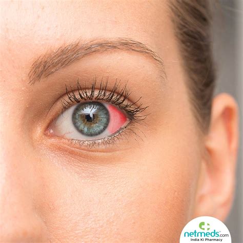 Red Dots Under Eyes Kidney Disease Dialysis And Your Eyes National