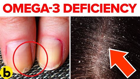 13 Signs And Symptoms Of Omega 3 Deficiency Youtube