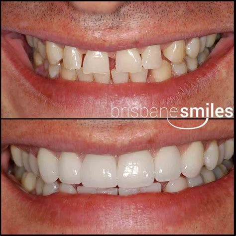 Porcelain Veneers Brisbane Cbd Cosmetic Dentist Brisbane Smiles