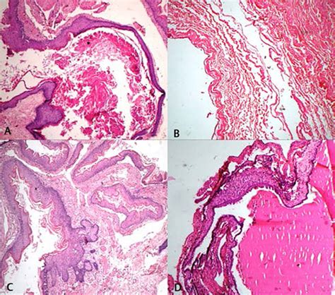 Epidermoid Cyst Showing Keratinized Stratified Squamous Epithelium