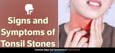 9 Common Symptoms Of Tonsil Stones 2022