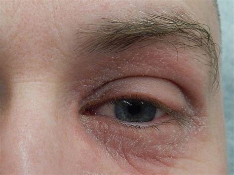 How To Treat Perioral Periocular Dermatitis Around The Eyes Balmonds