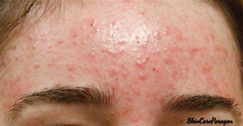 How To Get Rid Of Bumps On Forehead Forehead Acne Cause Forehead