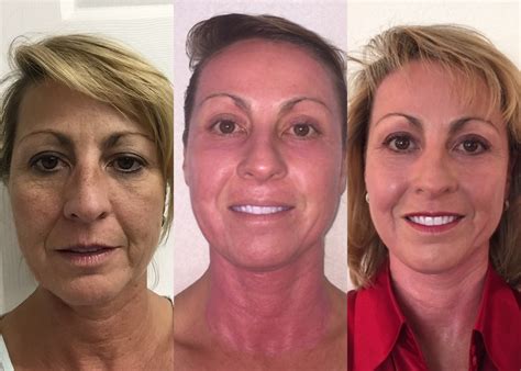 Plasma Skin Resurfacing Could Getting A Younger Looking Face Be Like A