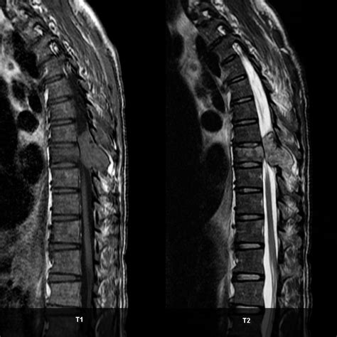 Spinal Metastasis With Cord Compression Image