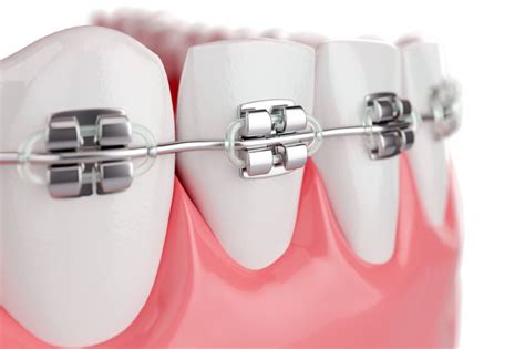 Orthodontic Toothcolored Brace Cost Turkeyantlara Dental Antalya