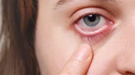 Eye Flu Cases On Rise In India 10 Tips To Keep Your Kids Safe From