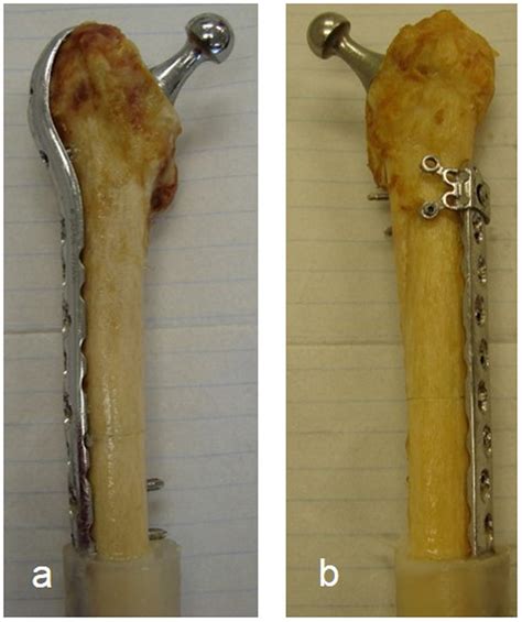 Plate Fixation In Periprosthetic Femur Fractures Vancouver Type B1