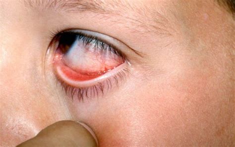 Parinaud Oculoglandular Syndrome Causes And Treatment Obn