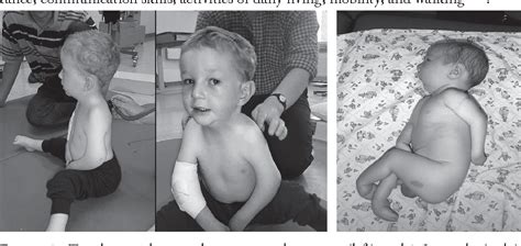 Pdf Arthrogryposis Causes Consequences And Clinical Course In Amyoplasia And Distal