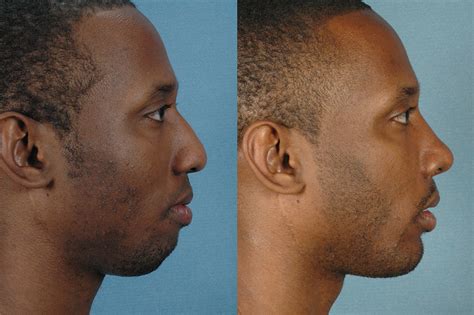 Chin Augmentation Pictures Champaign Chin Implant Before And After