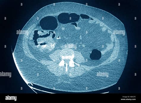 Colon Cancer Ct Scan Stock Photo Alamy