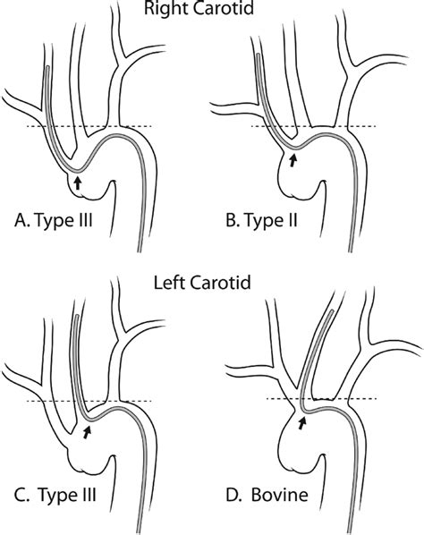 Schematic Examples Of Unfavorable Aortic Arch Anatomy A Type Iii
