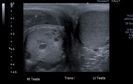 Testicular Infarction And Epididymitis Radiology Case Radiopaedia Org