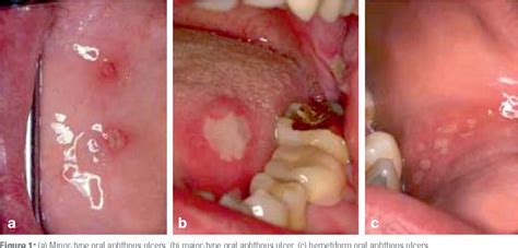 The Treatment Of Chronic Recurrent Oral Aphthous Ulcers Semantic Scholar