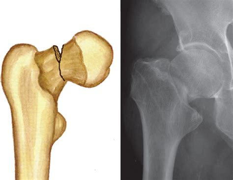 Fractures Of The Femur Musculoskeletal Key