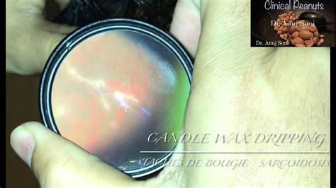 Candle Wax Dripping Taches De Bougie Sign Of Ocular Sarcoidosis Youtube