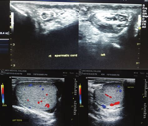 Transverse Ultrasound At The Root Of Scrotum Showing Left Funiculitis