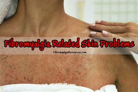 Fibromyalgia Related Skin Problems And Their Managment Fibromyalgia