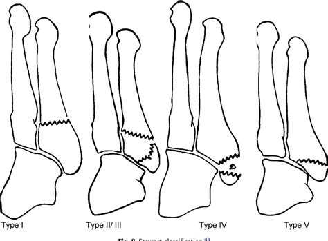 Figure From Fractures Of The Fifth Metatarsal Diagnosis And