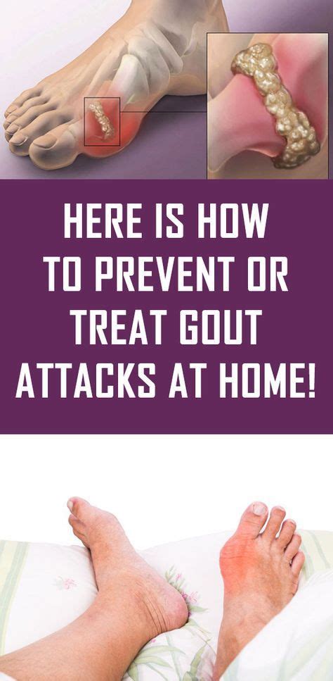 Here Is How To Prevent Or Treat Gout Attacks At Home Gout Attack