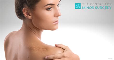 Keloid Scars Centre For Minor Surgery