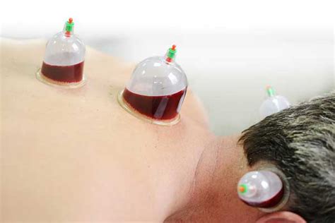 Cupping Therapy Types Benefits And Adverse Effect How To Relief