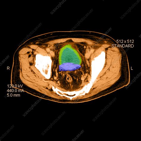 Ct Of Prostate Cancer Stock Image F0312755 Science Photo Library