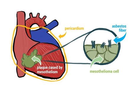 Pericardial Mesothelioma Mesothelioma Affecting The Heart