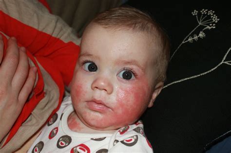 House Of Thorns Infant Eczema Allergies And Why Im Not Just Your