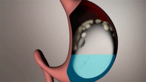 Gastric Balloon That Can Be Swallowed In Pill Form Could Help Solve