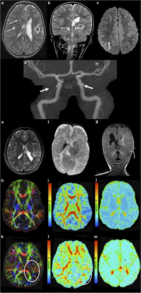 Brain Mri Of Patients With Col4a2 Mutations A B Axial And Coronal