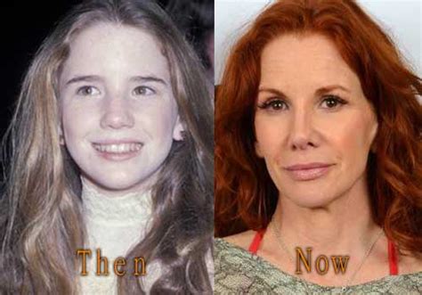 Melissa Gilbert Plastic Surgery Before And After Top Celebrity Surgery