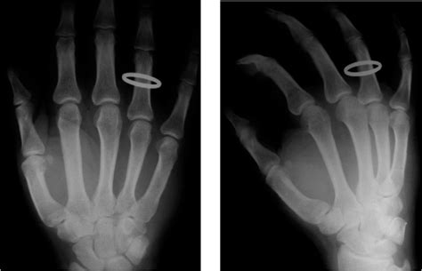 Figure 2 from Ulnar sesamoid's fracture of the thumb: an ...