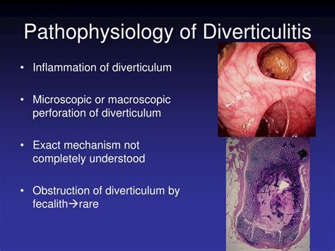 Ppt Inflammatory Bowel Disease Diverticulitis And Inflammatory My Xxx