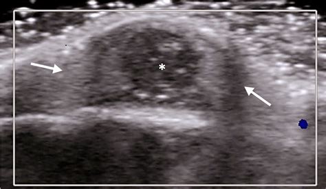 Trichilemmal Cyst In An 11 Month Old Girl Presenting With A Right
