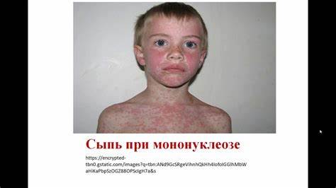 Диеты при эпштейн барр