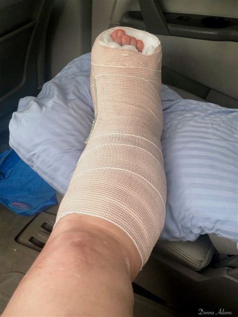 Splint Post Pttd Flat Foot Surgery Foot Surgery Surgery Reconstruction