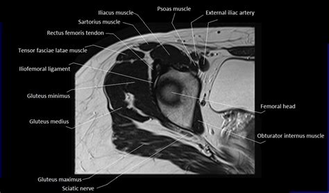 Perform routine foot plus coronal fmpspgr fat saturated pre and post gad images and axial post gad fmpspgr fat saturated images. MRI anatomy of hip joint | free MRI axial hip anatomy