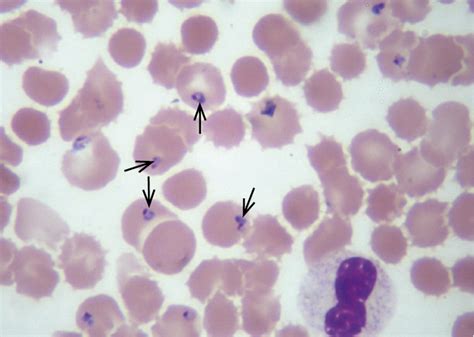 Celulas De Lupus Eritematoso En Frotis Sanguineo Consejos Celulares